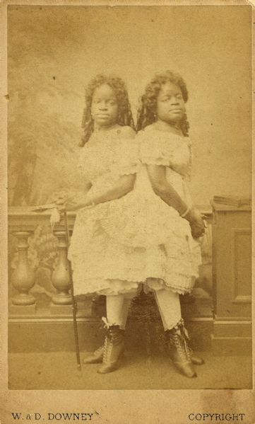 Born as Slaves -  Siamese Twins Millie and Christine