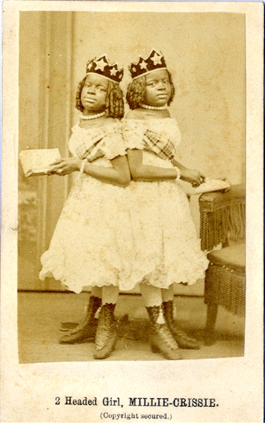 Conjoined  Twins - CDV